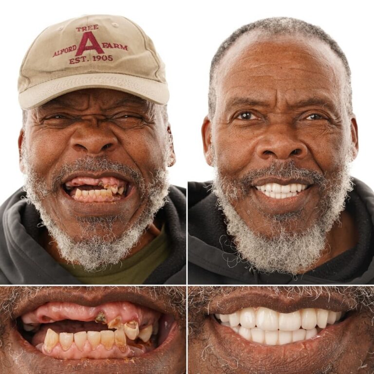 Snap-in denture transformation – Bill | LA Implants & Dentures Baton Rouge