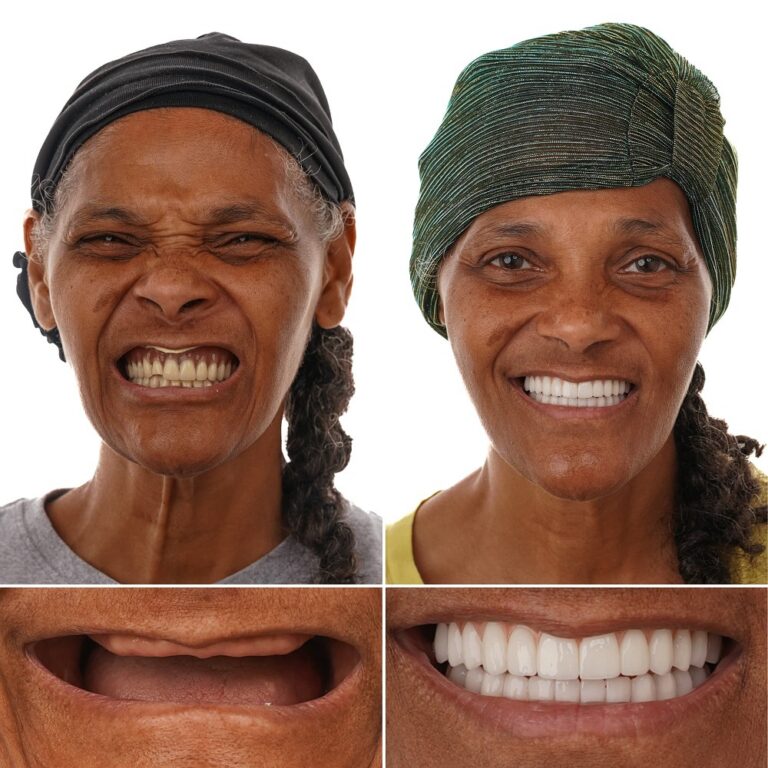 Full arch implant results – Billy G. – LA Implants & Dentures Baton Rouge