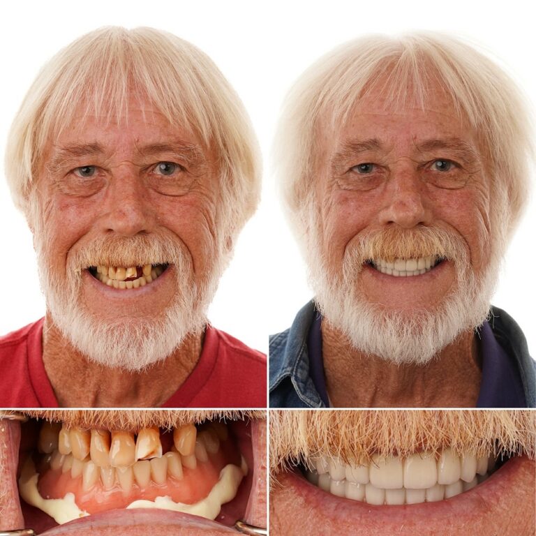 Dental implant before and after transformation – Charles C. – LA Implants & Dentures Baton Rouge