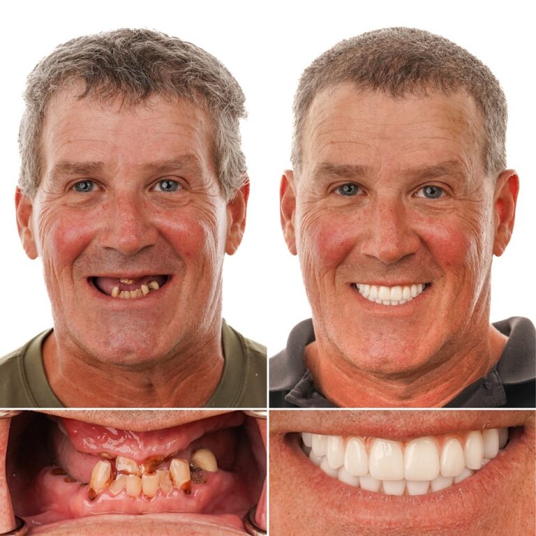 Dental implant transformation – Eric O. – LA Implants Baton Rouge Louisiana