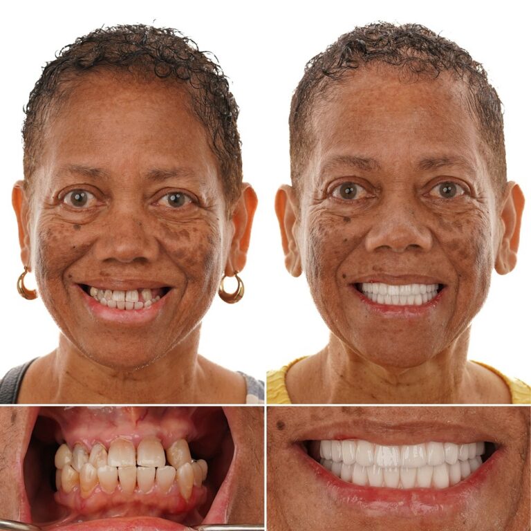 Denture implant transformation – Hazel P. – Baton Rouge LA