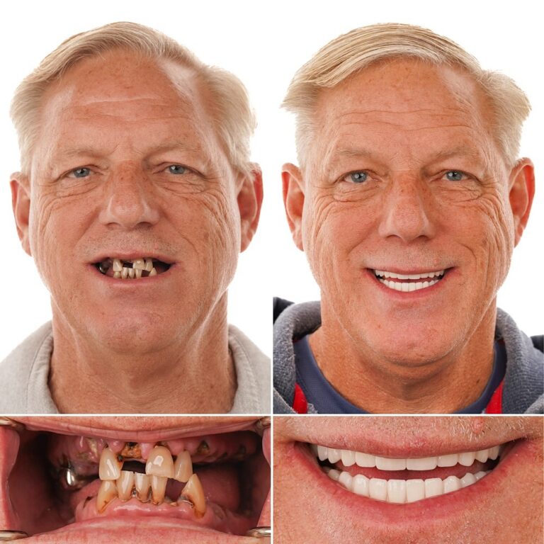 Full mouth implant transformation – Jerry S. – LA Implants Baton Rouge LA