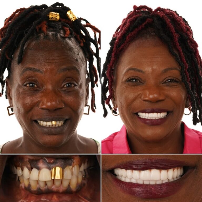 Dental implant smile transformation – Mary – Louisiana Implants & Dentures