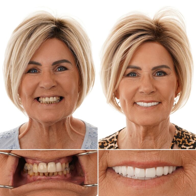 All-On-4 dental implant before and after - Baton Rouge dental implant results