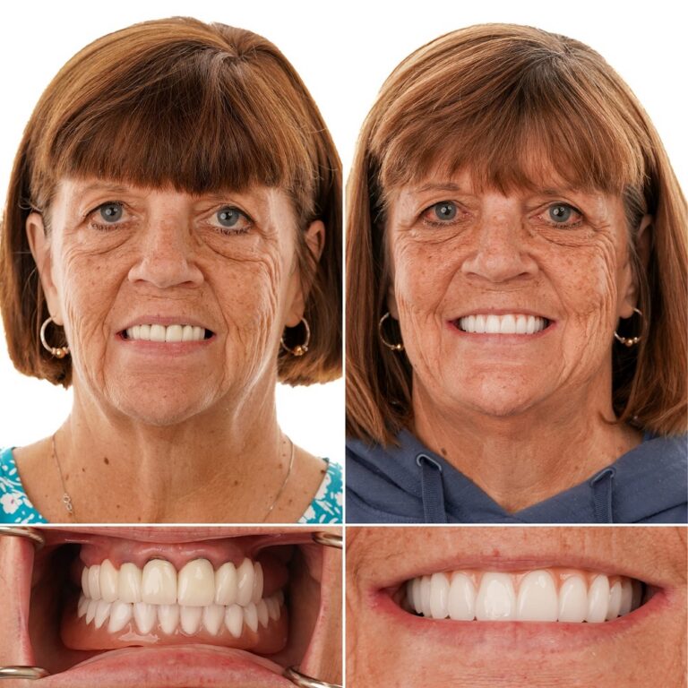 Implant denture before and after – Virginia D. – Baton Rouge dental implants